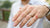 How Do You Get Rid Of Wedding Ring Rash