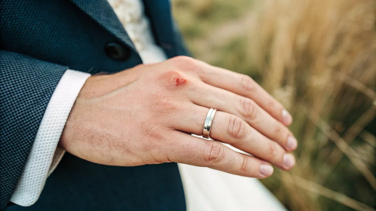 How to Stop Wedding Ring Rash