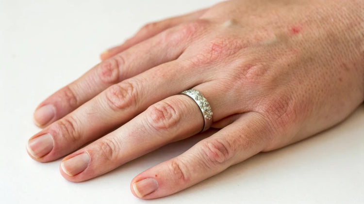 Why Am I Suddenly Allergic To My Wedding Ring