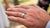How to Get a Wedding Ring Off a Swollen Finger