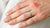 How to Treat Wedding Ring Rash